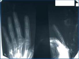 рентгенограма кисті дитини н. від 17.02.16 (виключення кісткового ураження при панариції)