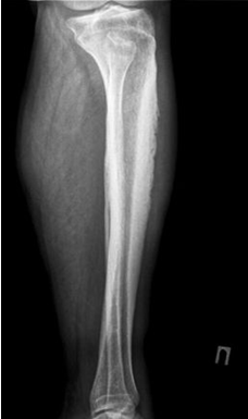 рентгенограмма при остеомиелите большеберцовой кости