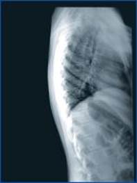 рентгенограма хребта дитини н. від 17.02.16 (виключення компресії тіл хребців
