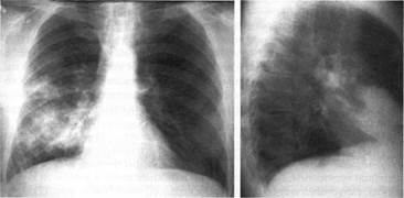рентгенограмма больного м., 47 лет, в прямой