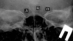 рентгеновский снимок лобных пазух. л, ц, п - левый, центральный и правый лепестки