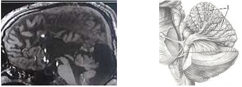 ямр-томограммы мозга рис 11. древо жизни червя мозжечка